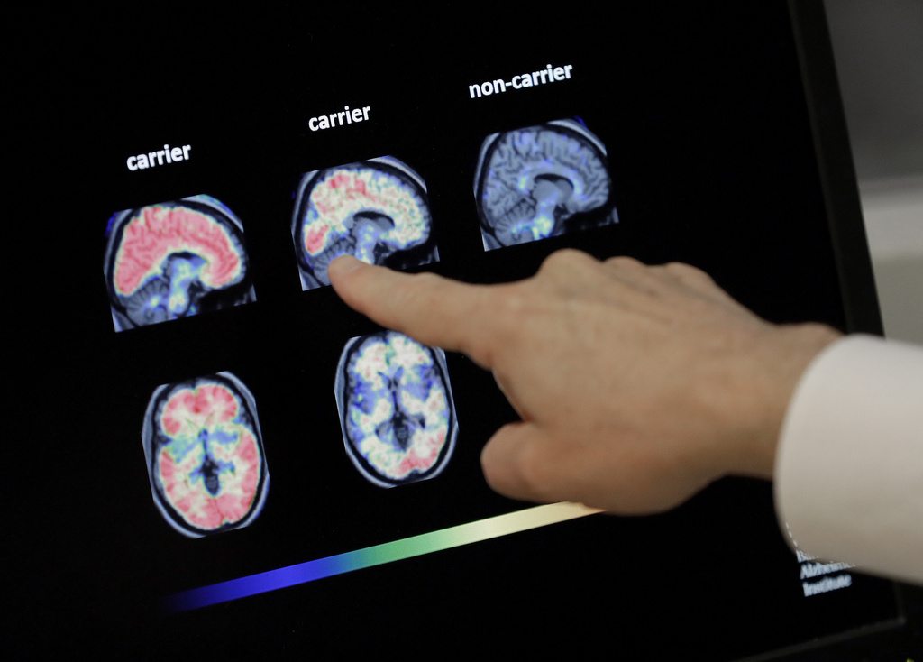 A hand points to brain scan images on a screen, comparing labeled sections carrier and non-carrier, each showing colorful patterns.